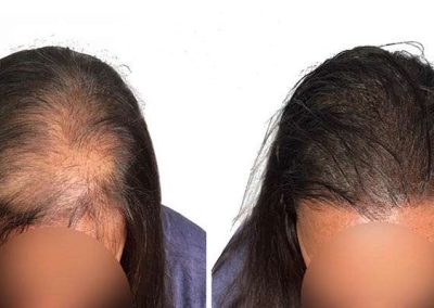 Scalp Micro Pigmentation Procedures in Bangkok, Thailand