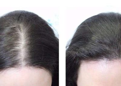 Scalp Micro Pigmentation Procedures in Bangkok, Thailand