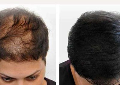 Scalp Micro Pigmentation Procedures in Bangkok, Thailand