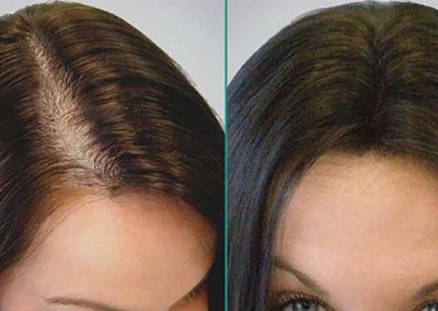 Scalp Micro Pigmentation Procedures in Bangkok, Thailand