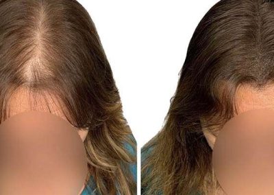 Scalp Micro Pigmentation Procedures in Bangkok, Thailand
