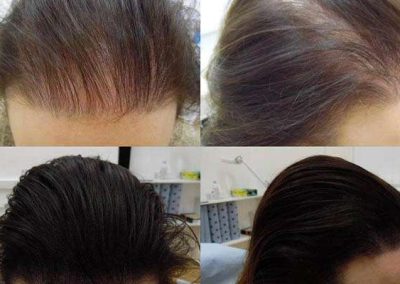 Scalp Micro Pigmentation Procedures in Bangkok, Thailand