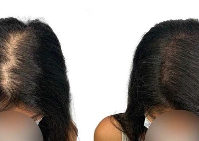 Scalp Micro Pigmentation Procedures in Bangkok, Thailand