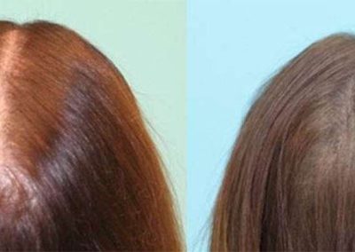 Scalp Micro Pigmentation Procedures in Bangkok, Thailand