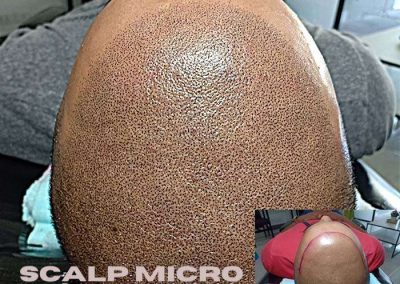Scalp Micro Pigmentation Procedures in Bangkok, Thailand