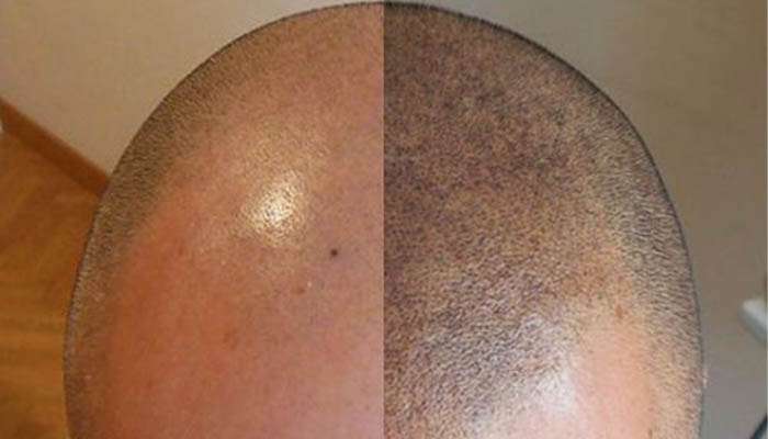 scalp-micro-pigmentation-bangkok-thailand