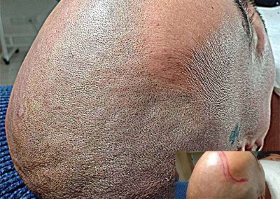 Scalp Micro Pigmentation Procedures in Bangkok, Thailand