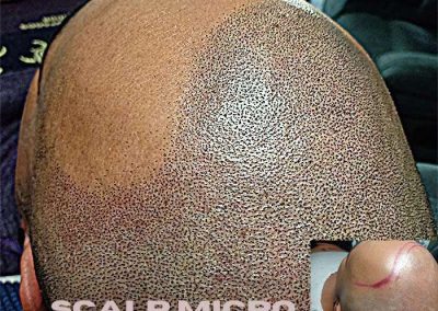 Scalp Micro Pigmentation Procedures in Bangkok, Thailand