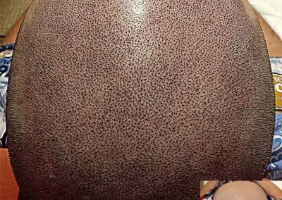 Scalp Micro Pigmentation Procedures in Bangkok, Thailand