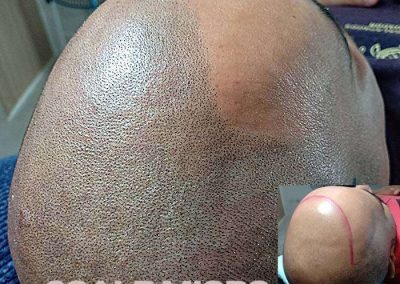 Scalp Micro Pigmentation Procedures in Bangkok, Thailand