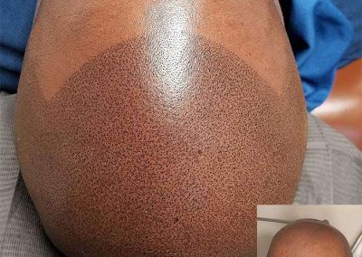Scalp Micro Pigmentation Procedures in Bangkok, Thailand