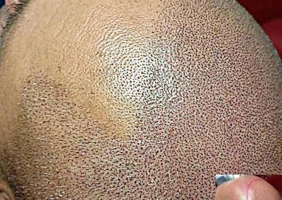 Scalp Micro Pigmentation Procedures in Bangkok, Thailand