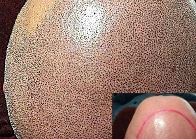 Scalp Micro Pigmentation Procedures in Bangkok, Thailand