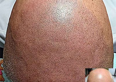 Scalp Micro Pigmentation Procedures in Bangkok, Thailand