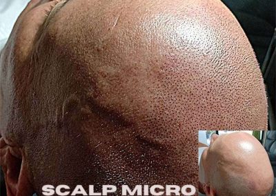 Scalp Micro Pigmentation Procedures in Bangkok, Thailand