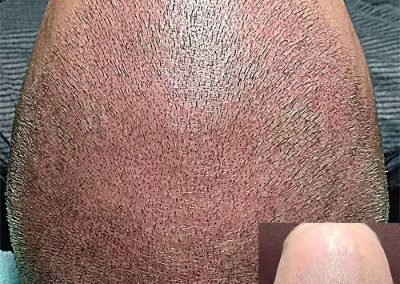 Scalp Micro Pigmentation Procedures in Bangkok, Thailand