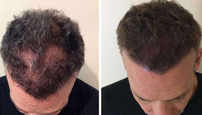 scalp-micro-pigmentation-bangkok-thailand