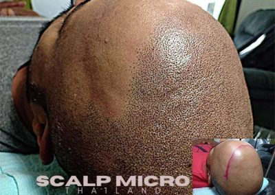 Scalp Micro Pigmentation Procedures in Bangkok, Thailand
