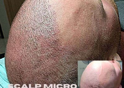 Scalp Micro Pigmentation Procedures in Bangkok, Thailand