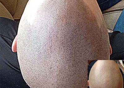 Scalp Micro Pigmentation Procedures in Bangkok, Thailand