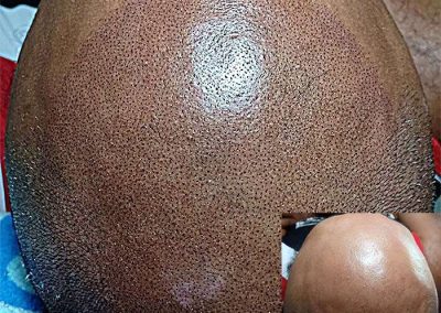 Scalp Micro Pigmentation Procedures in Bangkok, Thailand