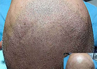 Scalp Micro Pigmentation Procedures in Bangkok, Thailand