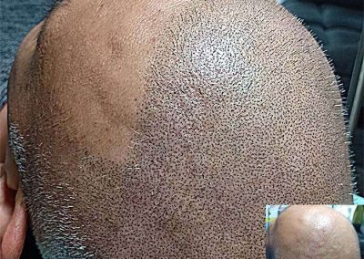 Scalp Micro Pigmentation Procedures in Bangkok, Thailand