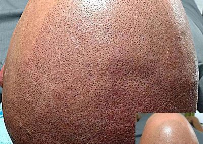 Scalp Micro Pigmentation Procedures in Bangkok, Thailand