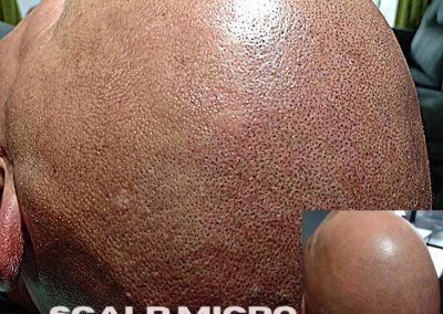 Scalp Micro Pigmentation Procedures in Bangkok, Thailand