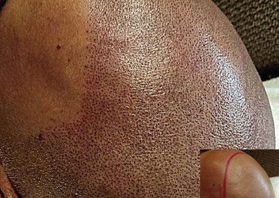 Scalp Micro Pigmentation Procedures in Bangkok, Thailand