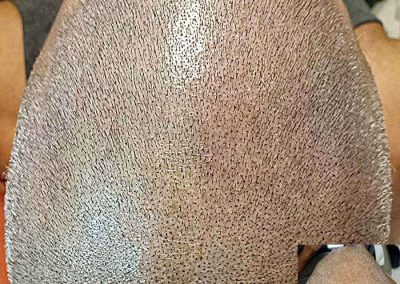 Scalp Micro Pigmentation Procedures in Bangkok, Thailand