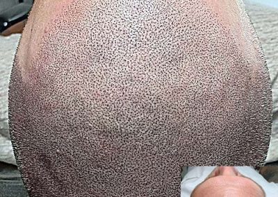 Scalp Micro Pigmentation Procedures in Bangkok, Thailand