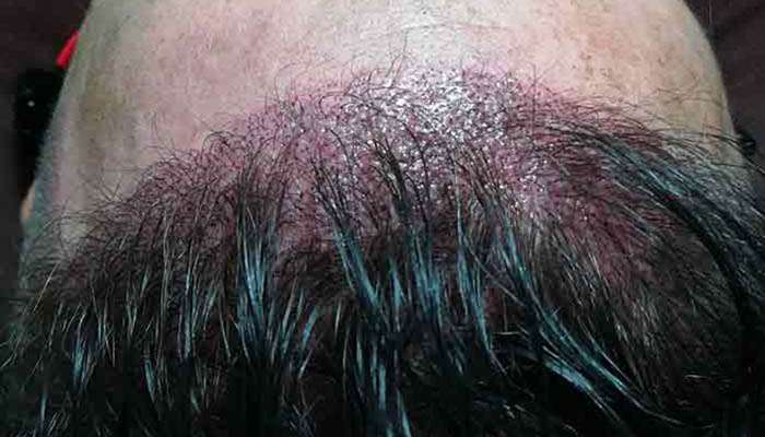 scalp-micro-pigmentation-bangkok-thailand