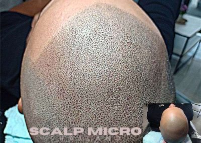 Scalp Micro Pigmentation Procedures in Bangkok, Thailand