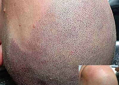Scalp Micro Pigmentation Procedures in Bangkok, Thailand