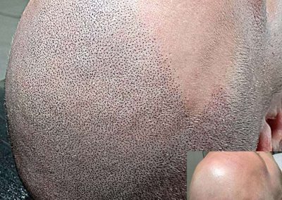 Scalp Micro Pigmentation Procedures in Bangkok, Thailand