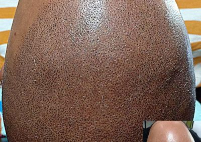 Scalp Micro Pigmentation Procedures in Bangkok, Thailand