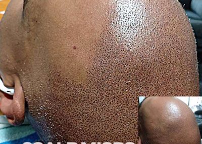 Scalp Micro Pigmentation Procedures in Bangkok, Thailand
