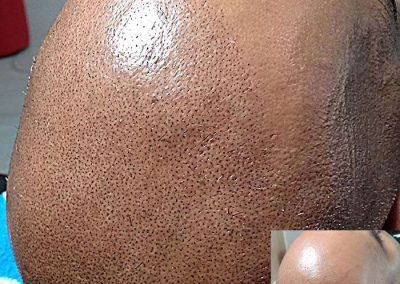 Scalp Micro Pigmentation Procedures in Bangkok, Thailand