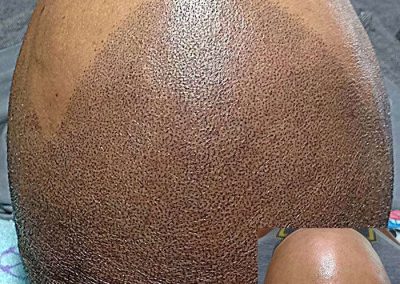 Scalp Micro Pigmentation Procedures in Bangkok, Thailand