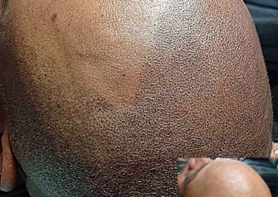 Scalp Micro Pigmentation Procedures in Bangkok, Thailand