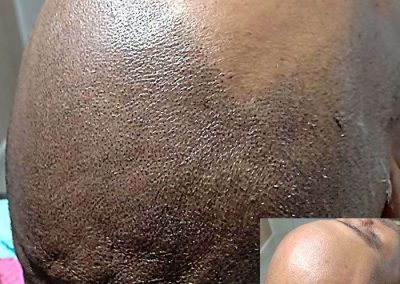 Scalp Micro Pigmentation Procedures in Bangkok, Thailand