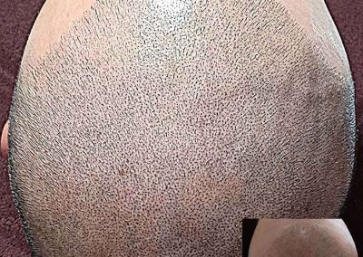 Scalp Micro Pigmentation Procedures in Bangkok, Thailand