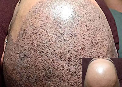 Scalp Micro Pigmentation Procedures in Bangkok, Thailand