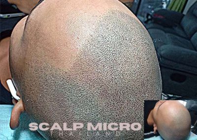 Scalp Micro Pigmentation Procedures in Bangkok, Thailand