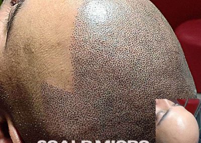 Scalp Micro Pigmentation Procedures in Bangkok, Thailand