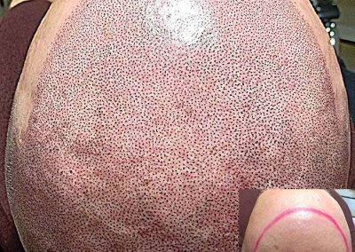 Scalp Micro Pigmentation Procedures in Bangkok, Thailand