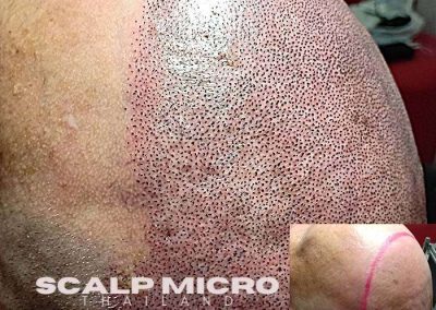 Scalp Micro Pigmentation Procedures in Bangkok, Thailand