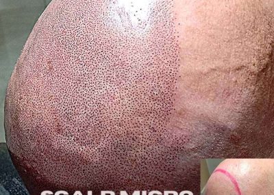 Scalp Micro Pigmentation Procedures in Bangkok, Thailand