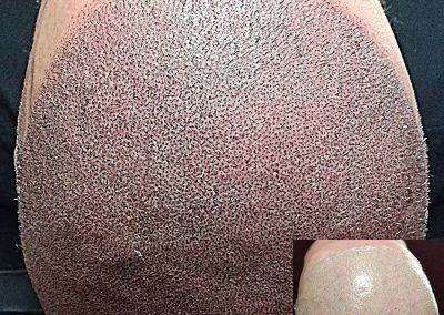 Scalp Micro Pigmentation Procedures in Bangkok, Thailand